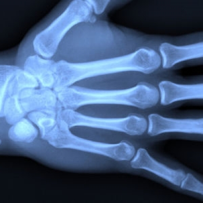 Рентген суставов руки